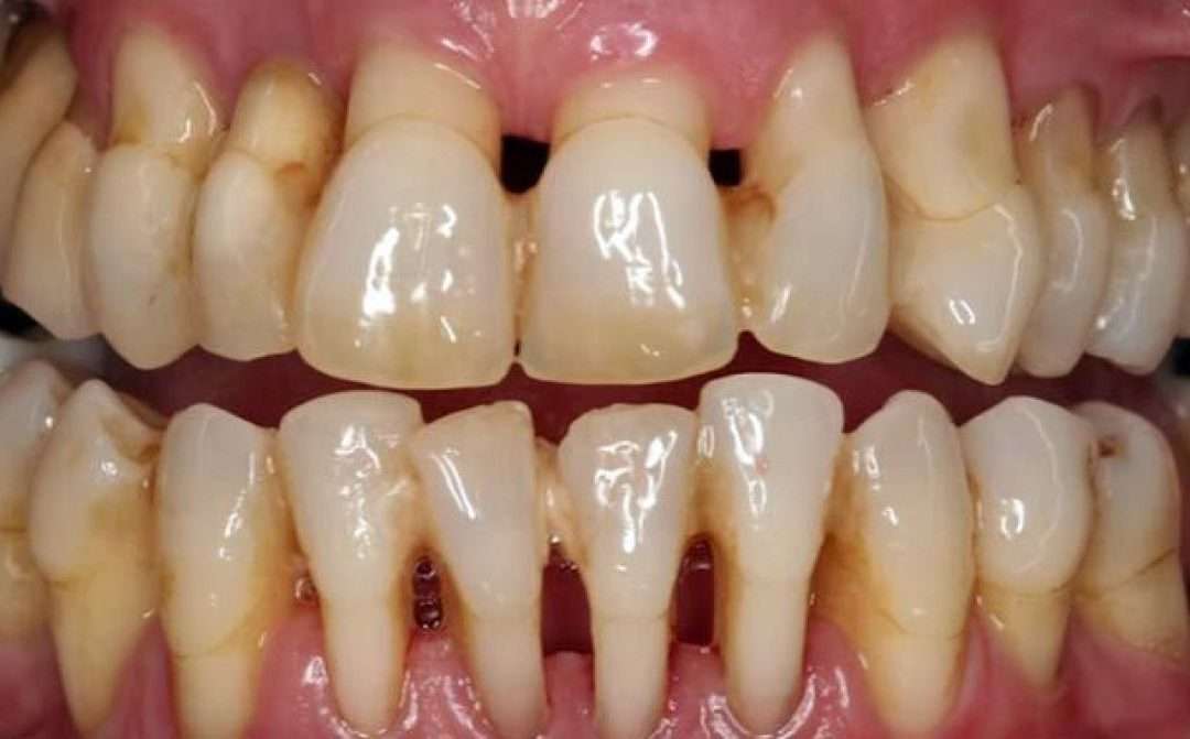 Cos’è la parodontite?