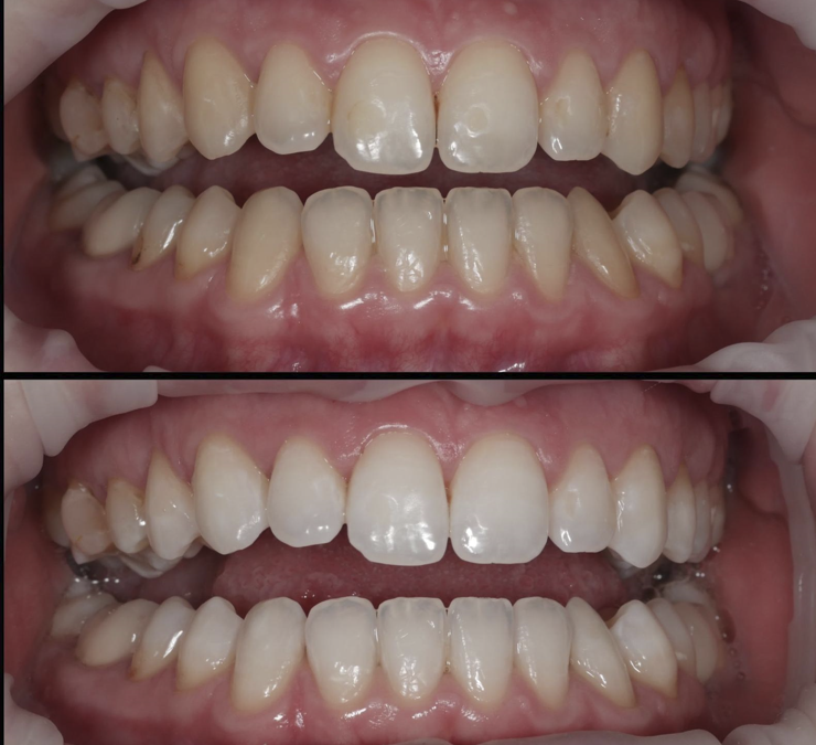 Sbiancamento dentale domiciliare