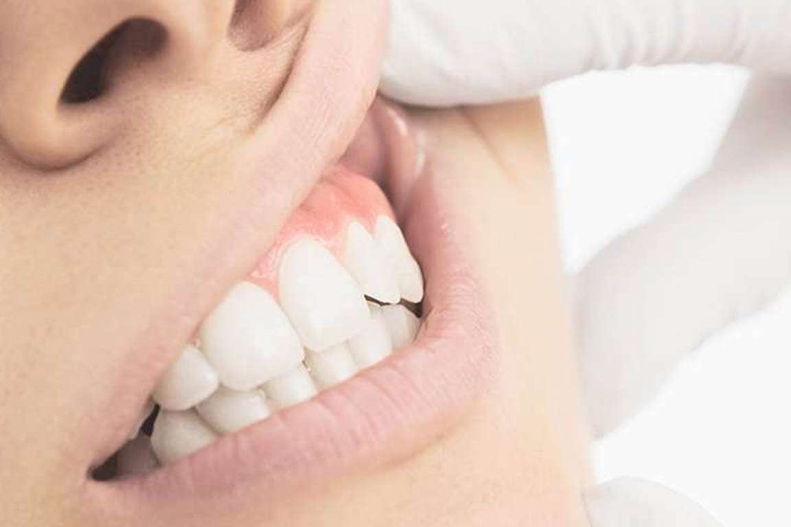 Interventi di parodontologia studio dentistico Edenta Cadelbosco di Sopra Reggio Emilia preventivo Parodontologia