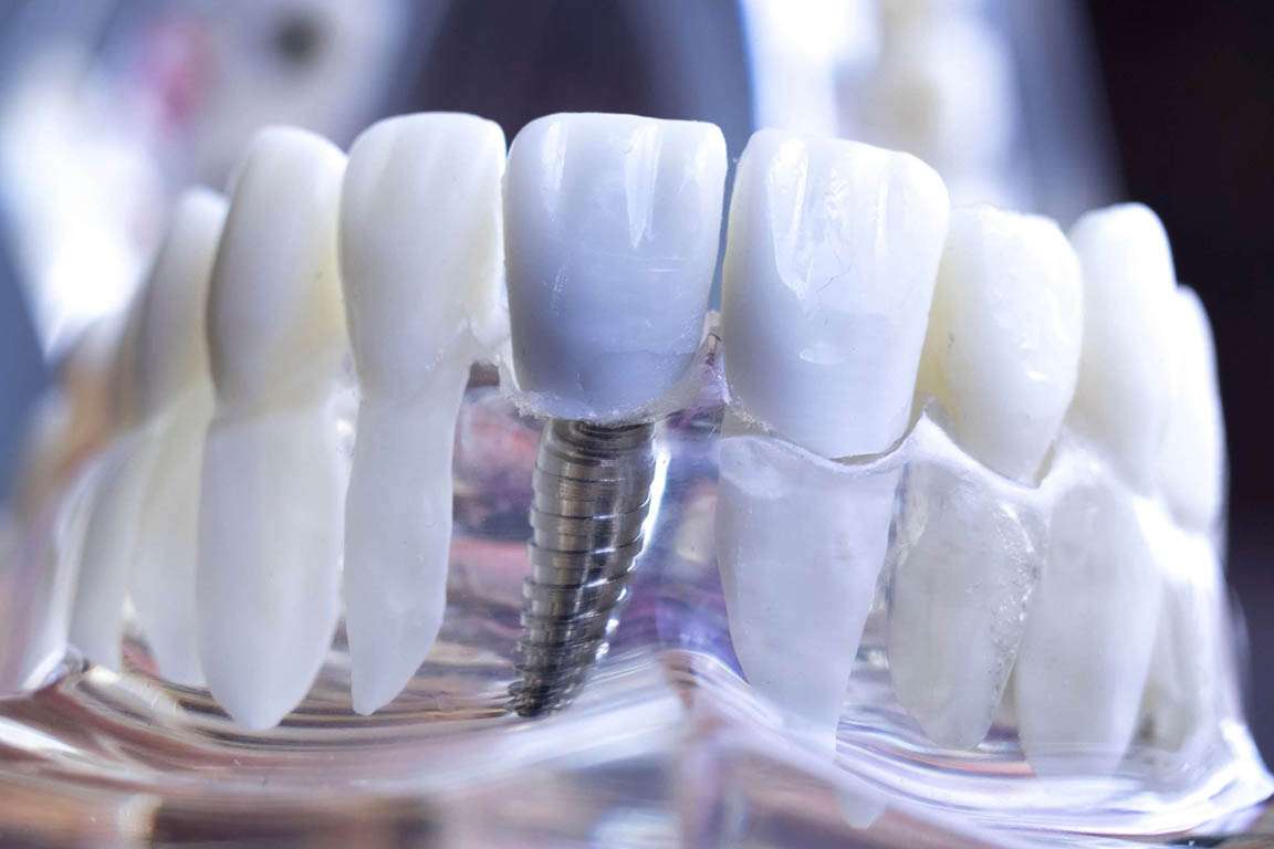 Trattamenti di implantologia dentale studio dentistico Edenta Cadelbosco di Sopra Reggio Emilia preventivo Implantologia