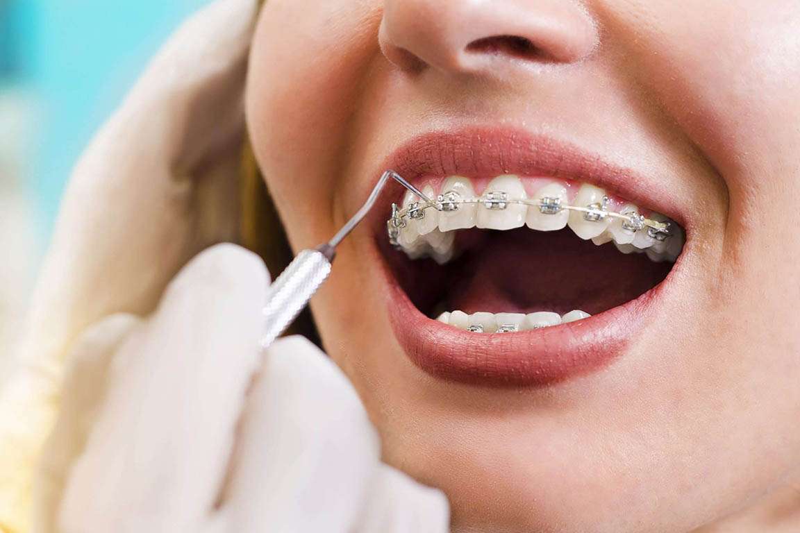 Trattamenti di ortodonzia studio dentistico Edenta Cadelbosco di Sopra Reggio Emilia preventivo Ortodonzia