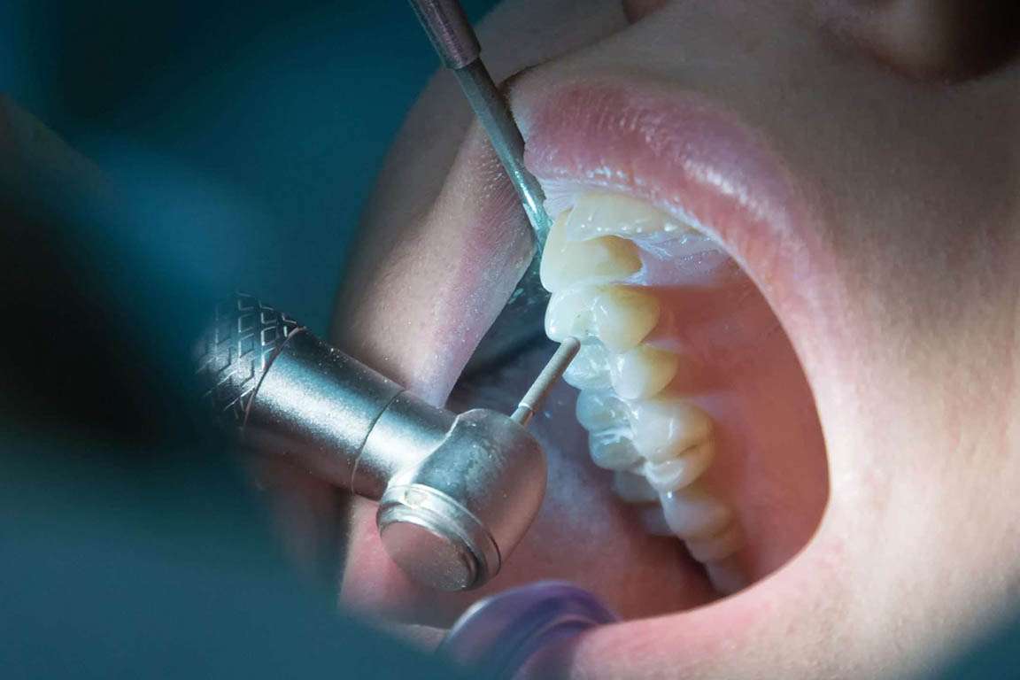 Trattamenti endodonzia studio dentistico Edenta Cadelbosco di Sopra Reggio Emilia preventivo Endodonzia